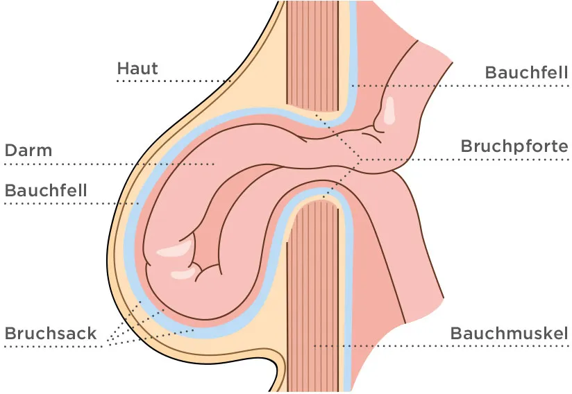 Schematische Darstellung einer Hernie (Bauchwandbruch)